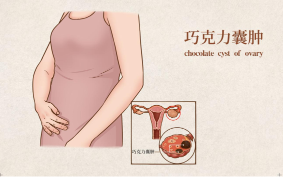 女性患有巧克力囊肿，不仅影响卵巢功能