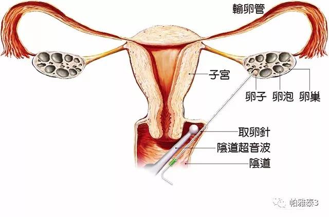 帕雅泰3试管婴儿促排取卵阶段