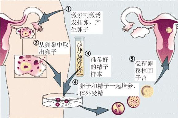 第一代、第二代和第三代试管的区别