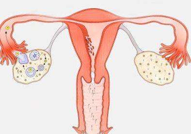 卵巢过度刺激综合症为体外受孕辅助生育的主要并发症之一
