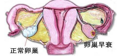 卵巢早衰是什么？