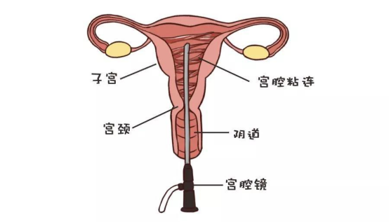 子宫粘连指由于破坏了子宫内膜而引起的宫腔粘连